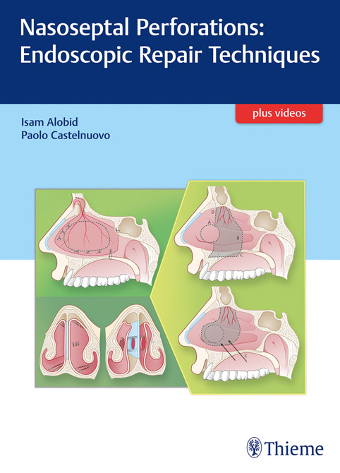 Nasoseptal Perforations: Endoscopic Repair Techniques