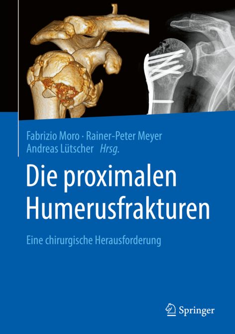 Die proximalen Humerusfrakturen