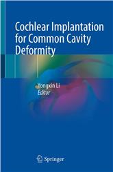 Cover Cochlear Implantation for Common Cavity Deformity
